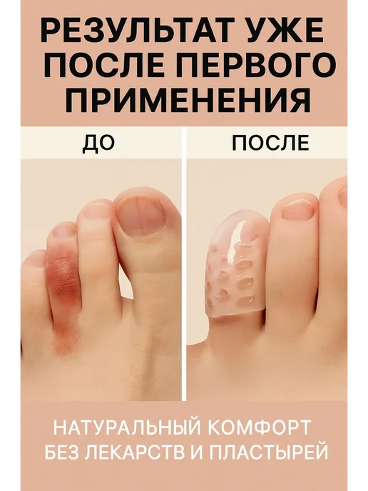 ВелЛуна Силиконовые защитные напальчники для пальцев ног от мозолей, 5 шт, фото 3