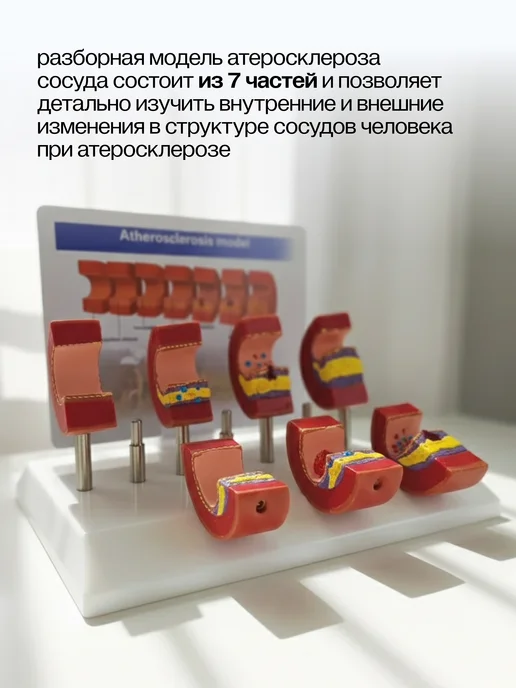 Дек Разборная анатомическая модель атеросклероза сосуда, вариант, фото 3