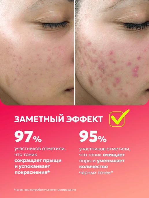 БьютиЦевтика Салициловый тоник для лица против прыщей с цинком и серебром, серебристый, фото 4