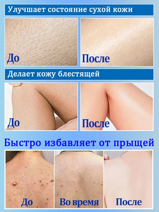 IUALLURE Гель для душа от прыщей на спине 300мл, 300 мл, фото 5